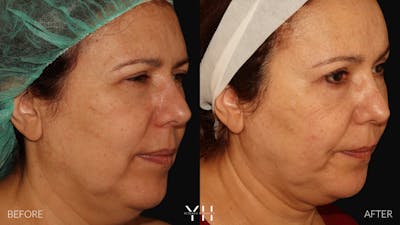 Necklift Before & After Gallery - Patient 212115 - Image 2