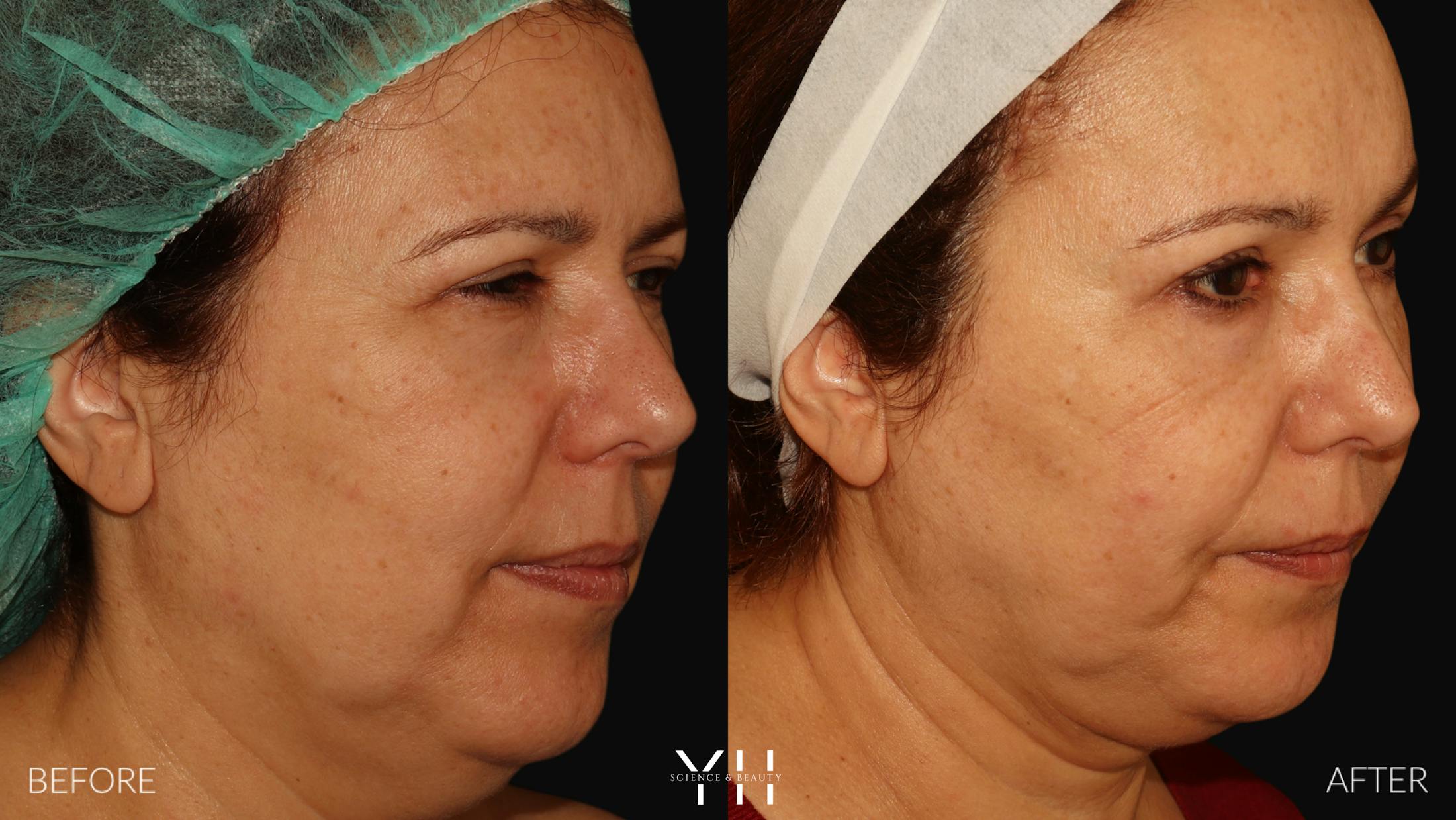 Necklift Before & After Gallery - Patient 212115 - Image 2