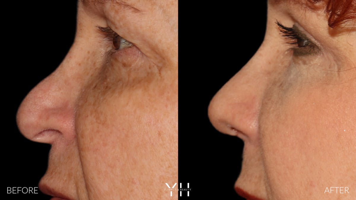 Rhinoplasty Before & After Gallery - Patient 251389 - Image 10