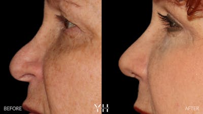 Rhinoplasty Before & After Gallery - Patient 251389 - Image 10