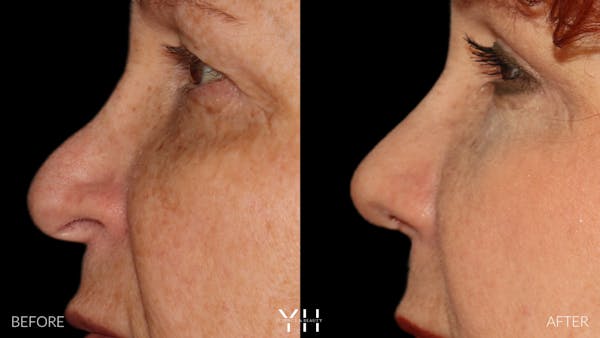 Rhinoplasty Before & After Gallery - Patient 251389 - Image 10