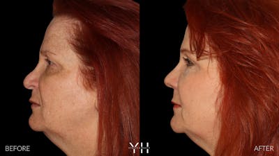 Rhinoplasty Before & After Gallery - Patient 251389 - Image 1