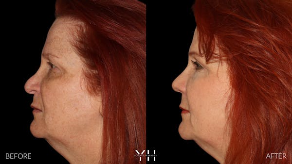 Rhinoplasty Before & After Gallery - Patient 251389 - Image 4