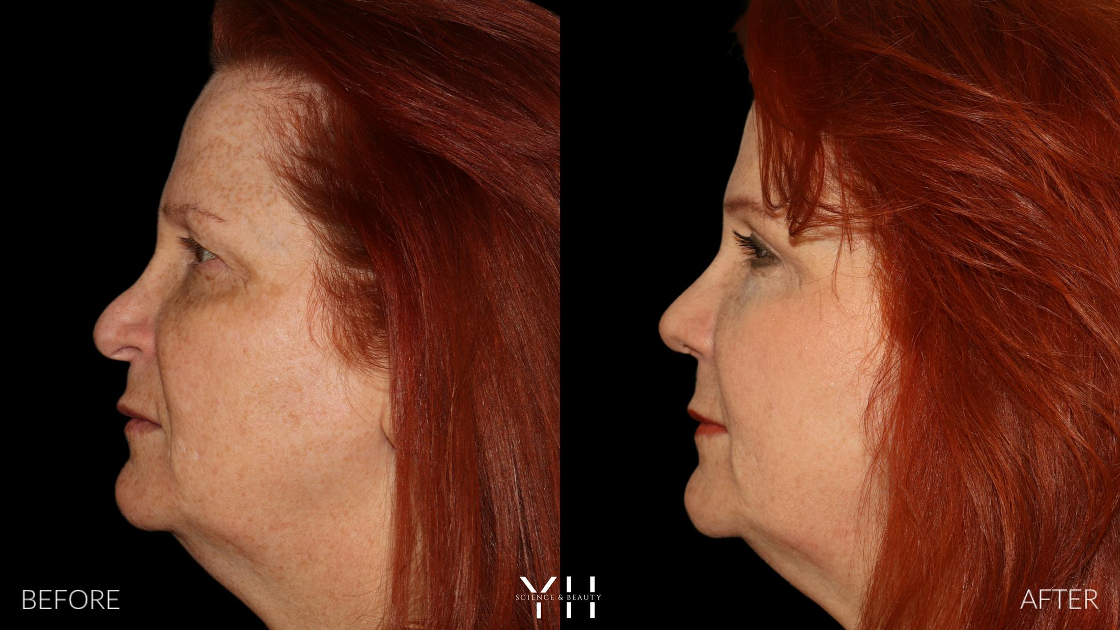 Rhinoplasty Before & After Gallery - Patient 251389 - Image 4