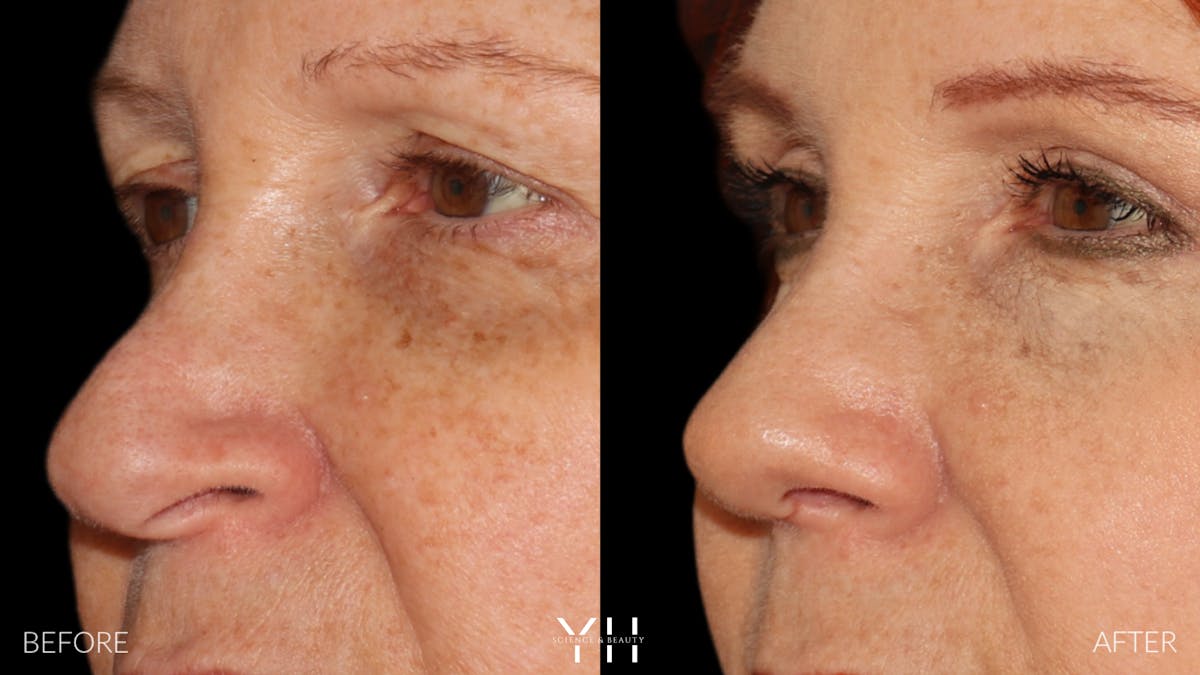 Rhinoplasty Before & After Gallery - Patient 251389 - Image 9