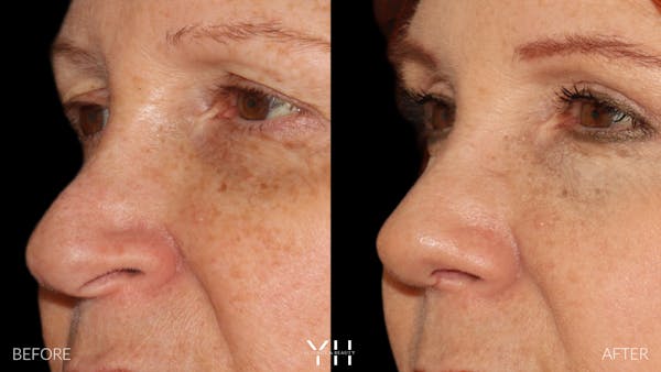 Rhinoplasty Before & After Gallery - Patient 251389 - Image 9
