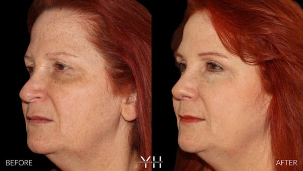 Rhinoplasty Before & After Gallery - Patient 251389 - Image 5