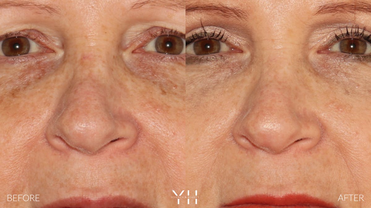 Rhinoplasty Before & After Gallery - Patient 251389 - Image 6