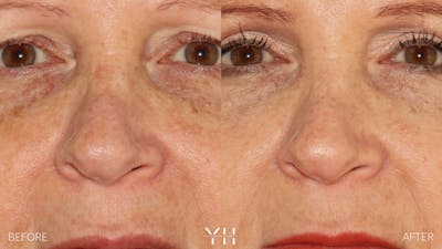 Rhinoplasty Before & After Gallery - Patient 251389 - Image 6