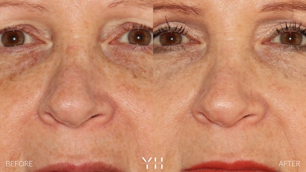 Rhinoplasty Before & After Gallery - Patient 251389 - Image 6