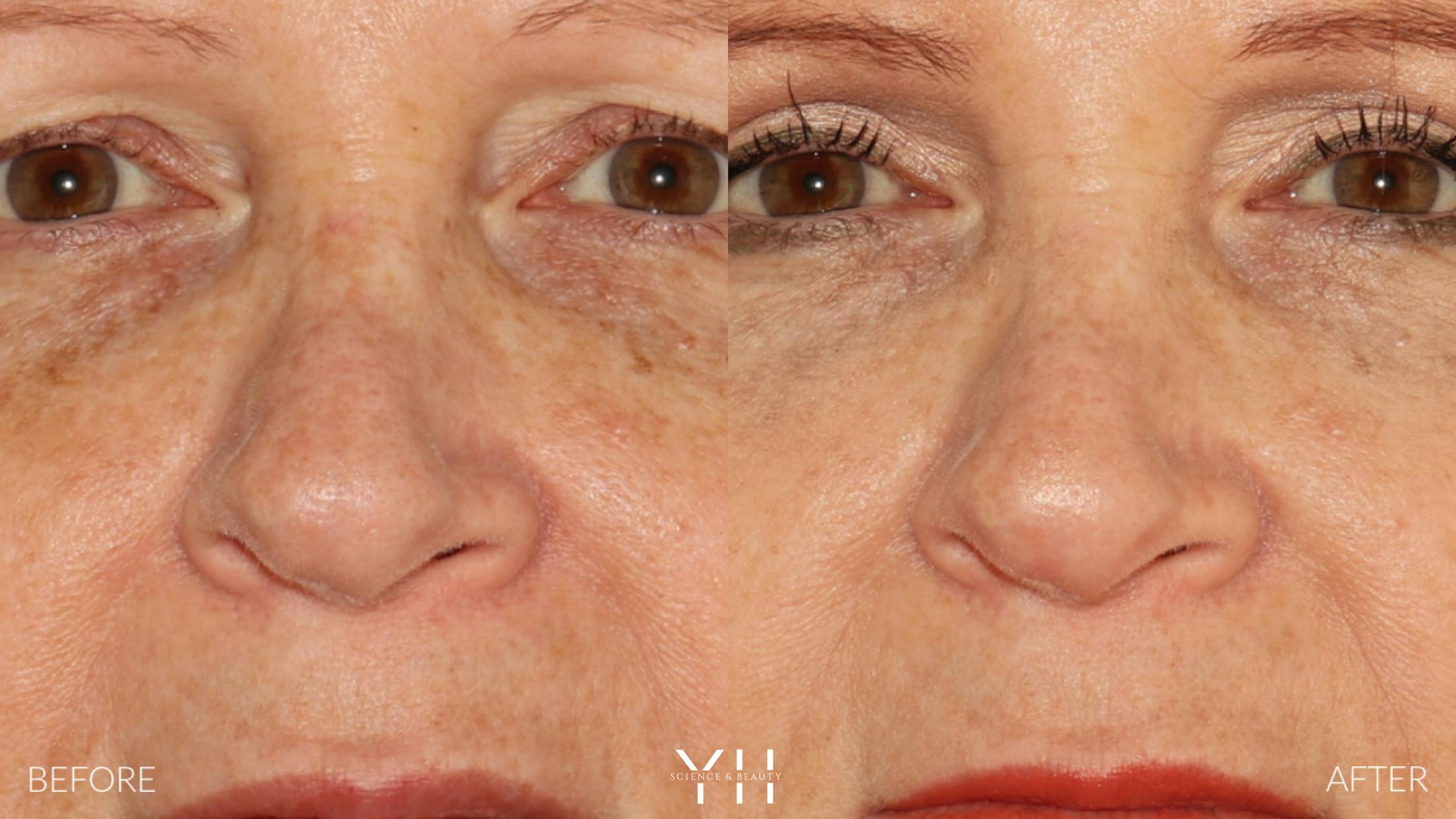 Rhinoplasty Before & After Gallery - Patient 251389 - Image 6