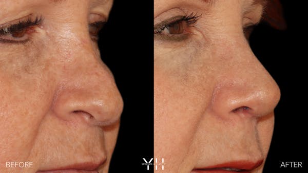 Rhinoplasty Before & After Gallery - Patient 251389 - Image 7