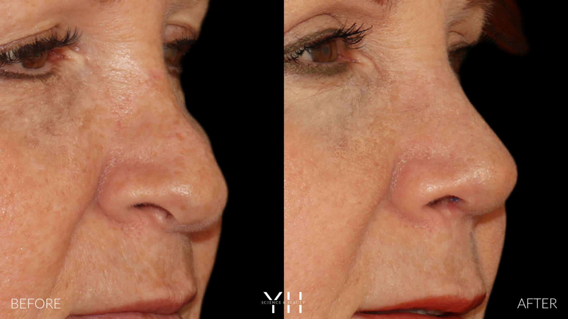 Rhinoplasty Before & After Gallery - Patient 251389 - Image 7