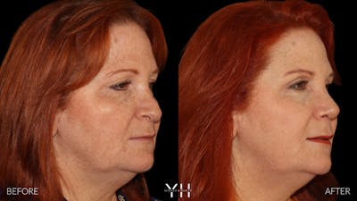 Rhinoplasty Before & After Gallery - Patient 251389 - Image 2