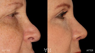 Rhinoplasty Before & After Gallery - Patient 251389 - Image 8