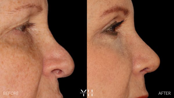 Rhinoplasty Before & After Gallery - Patient 251389 - Image 8