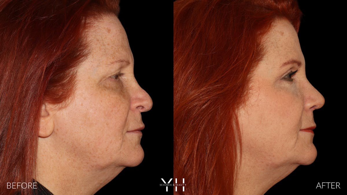 Rhinoplasty Before & After Gallery - Patient 251389 - Image 1