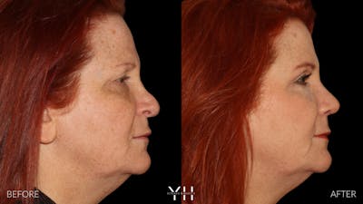 Rhinoplasty Before & After Gallery - Patient 251389 - Image 1