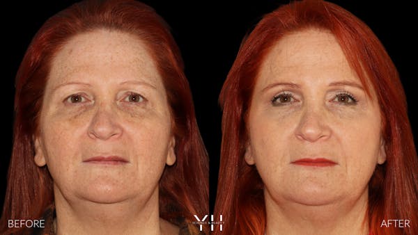 Rhinoplasty Before & After Gallery - Patient 251389 - Image 3
