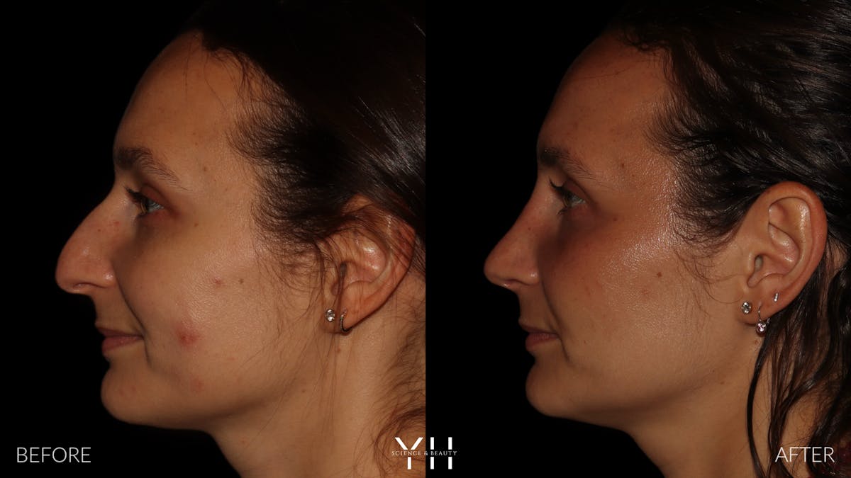 Rhinoplasty Before & After Gallery - Patient 297719 - Image 5