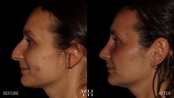 Rhinoplasty Before & After Gallery - Patient 297719 - Image 5