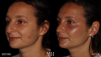 Rhinoplasty Before & After Gallery - Patient 297719 - Image 4