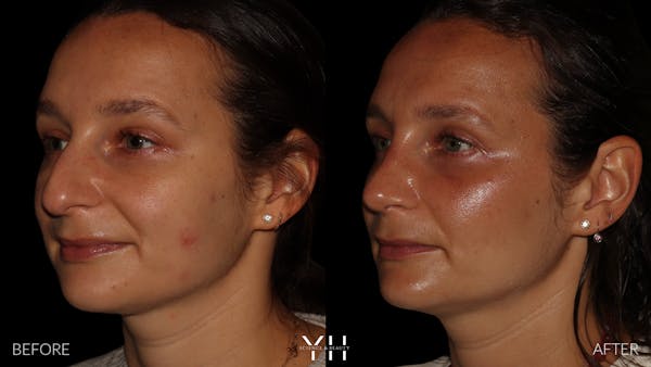 Rhinoplasty Before & After Gallery - Patient 297719 - Image 4