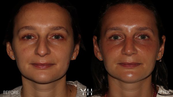 Rhinoplasty Before & After Gallery - Patient 297719 - Image 3