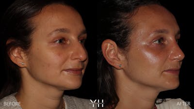 Rhinoplasty Before & After Gallery - Patient 297719 - Image 2