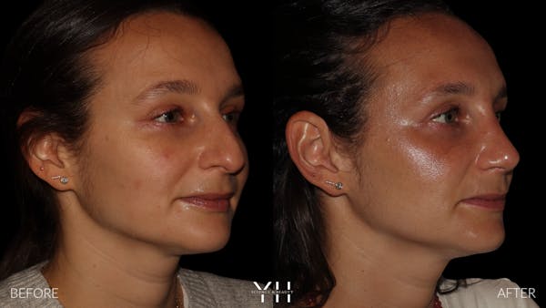 Rhinoplasty Before & After Gallery - Patient 297719 - Image 2