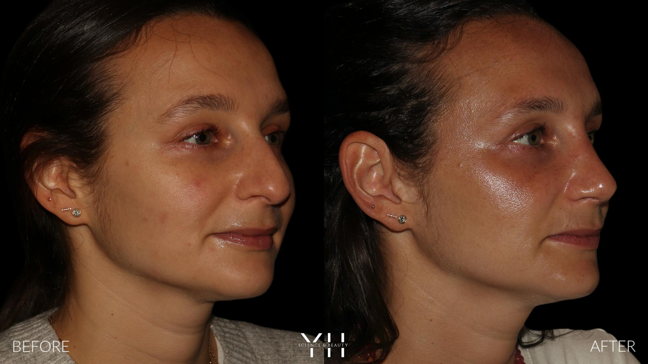 Rhinoplasty Before & After Gallery - Patient 297719 - Image 2