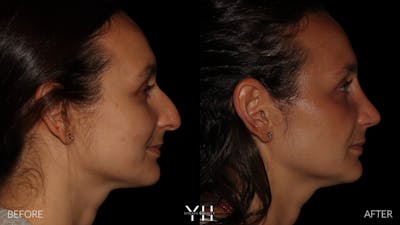 Rhinoplasty Before & After Gallery - Patient 297719 - Image 1