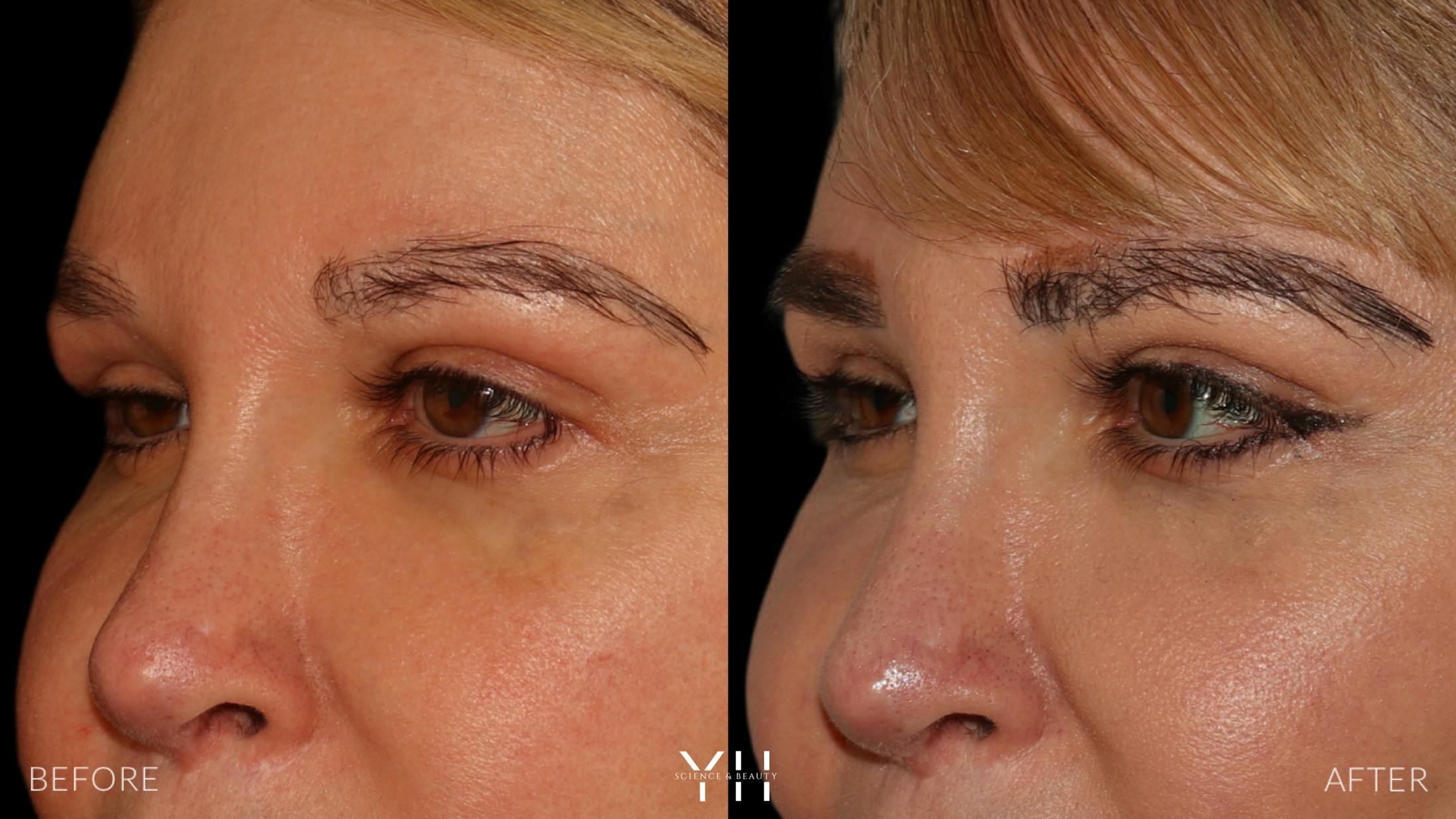 Eyebrow Transplant Before & After Gallery - Patient 391327 - Image 4