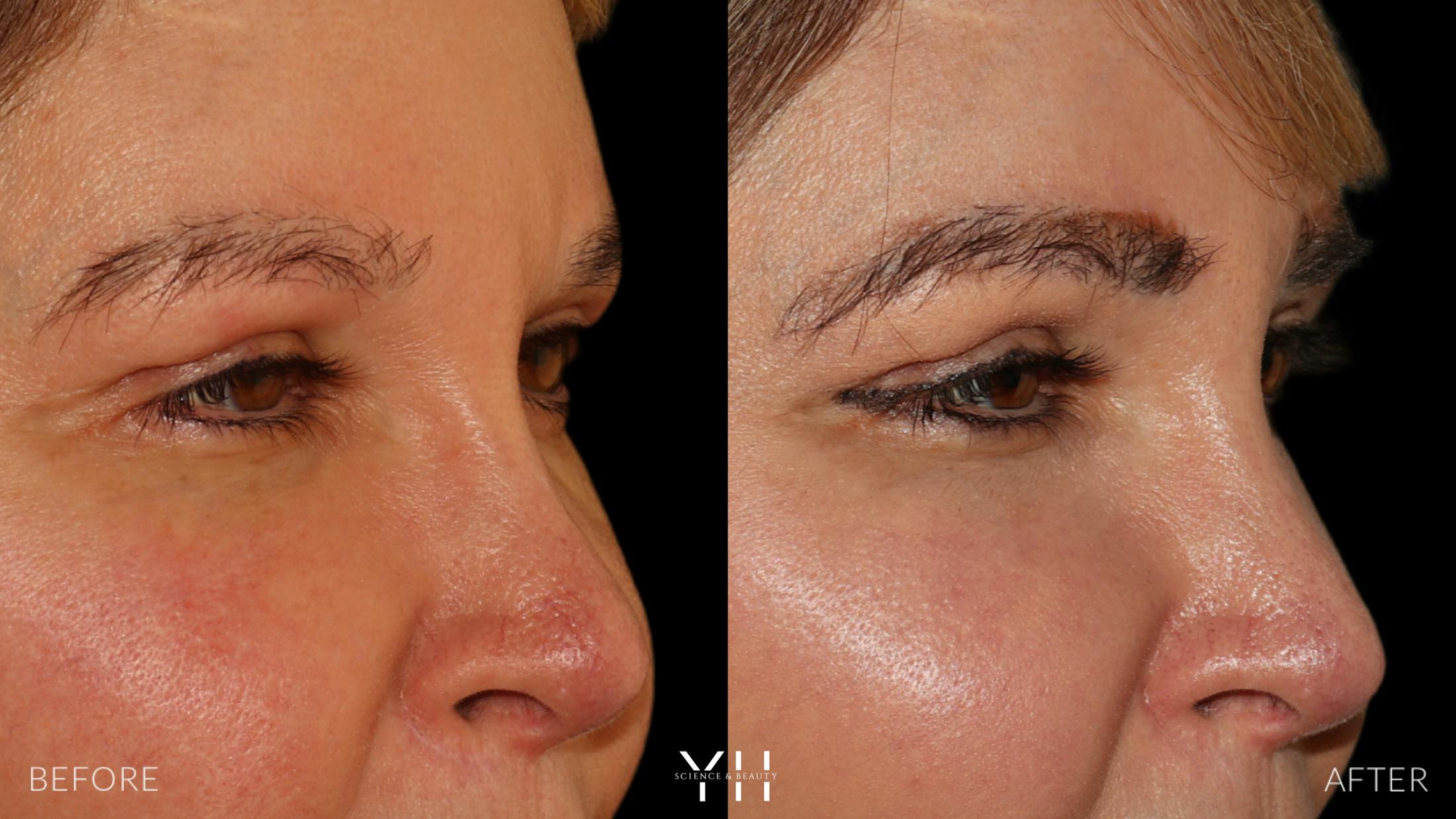 Eyebrow Transplant Before & After Gallery - Patient 391327 - Image 2