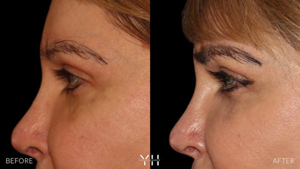 Eyebrow Transplant Before & After Gallery - Patient 391327 - Image 5