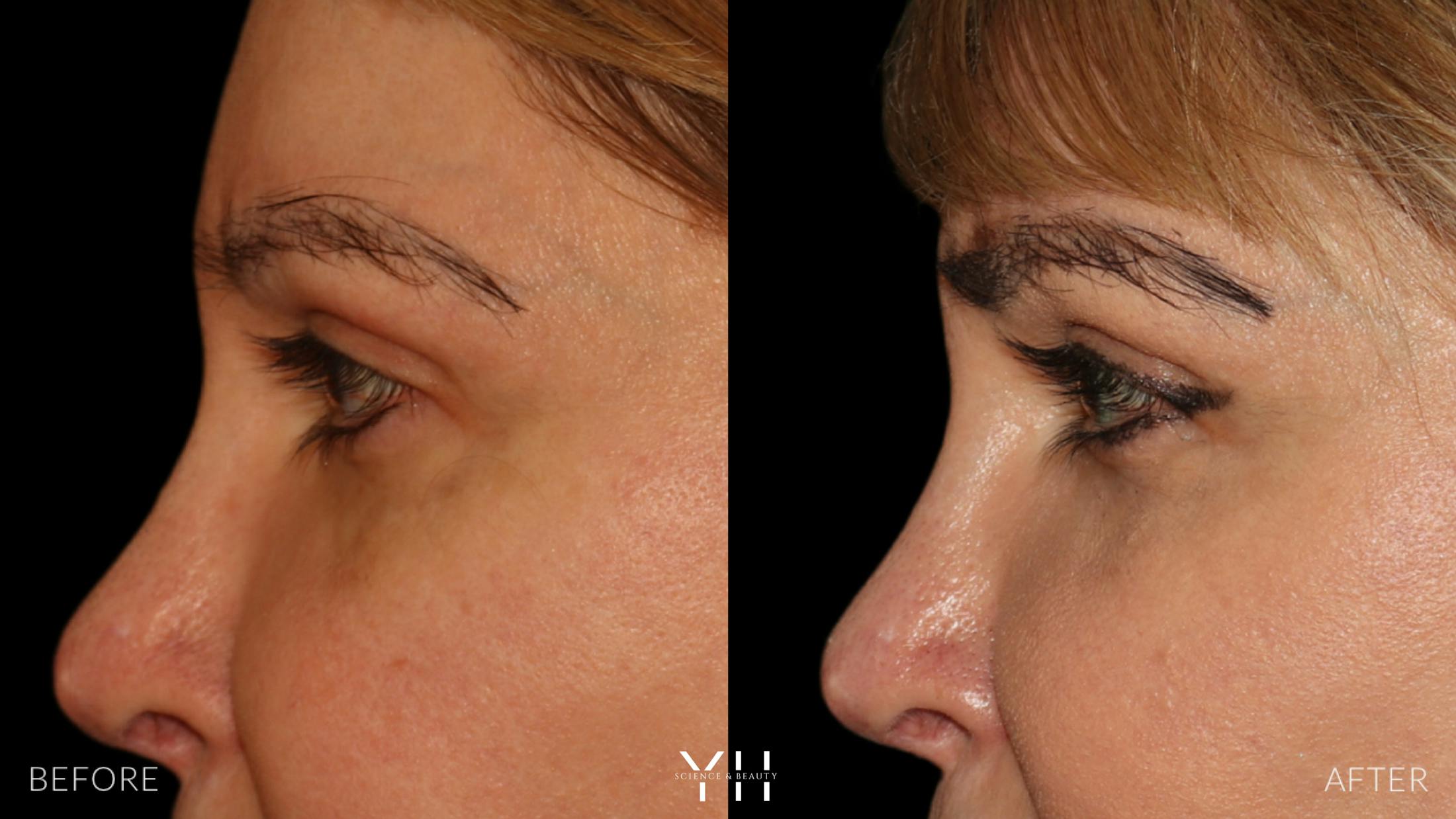 Eyebrow Transplant Before & After Gallery - Patient 391327 - Image 5