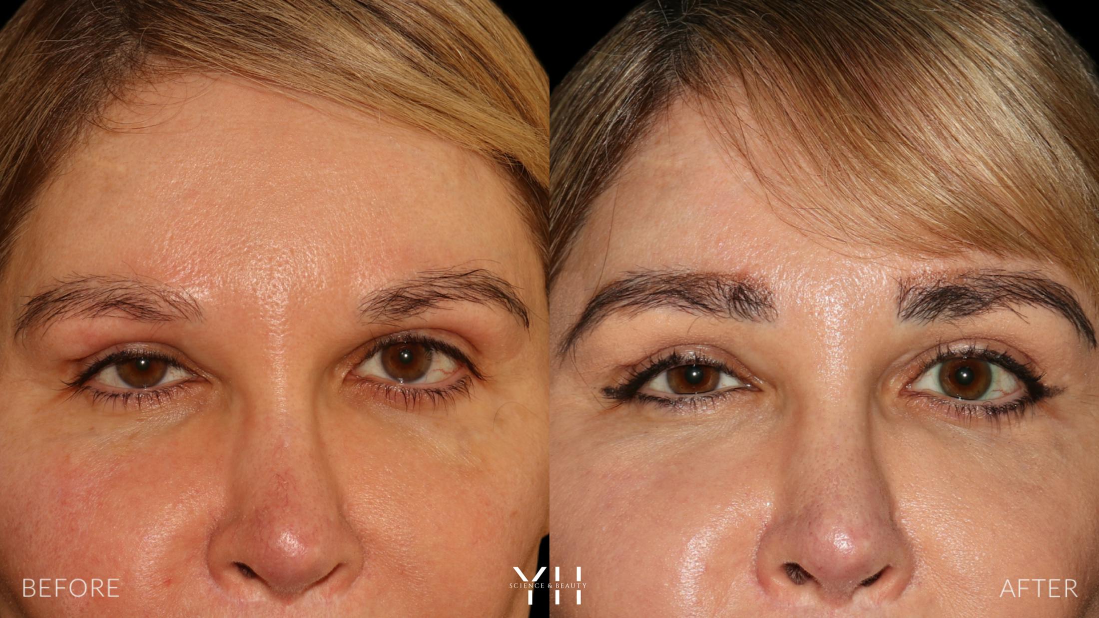 Eyebrow Transplant Before & After Gallery - Patient 391327 - Image 1