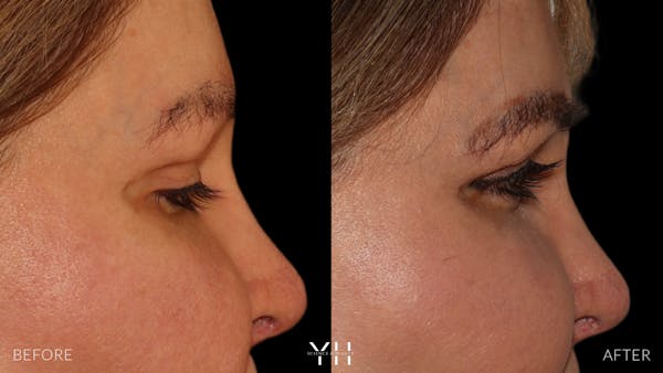 Eyebrow Transplant Before & After Gallery - Patient 391327 - Image 3
