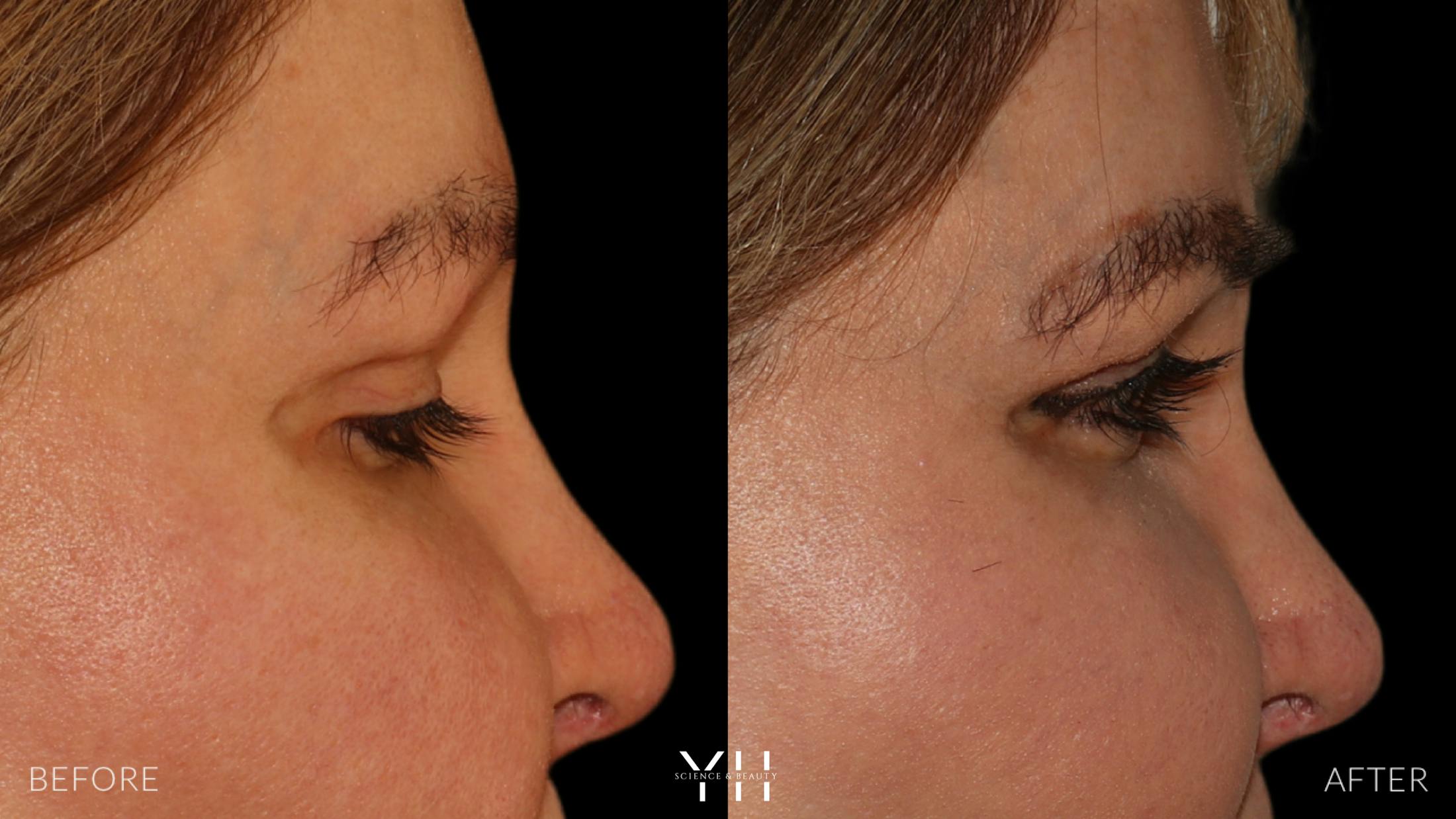 Eyebrow Transplant Before & After Gallery - Patient 391327 - Image 3