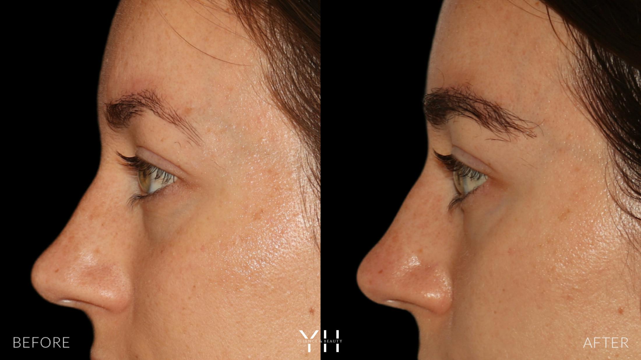 Eyebrow Transplant Before & After Gallery - Patient 234954 - Image 5