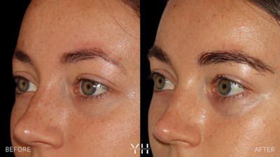 Eyebrow Transplant Before & After Gallery - Patient 234954 - Image 4