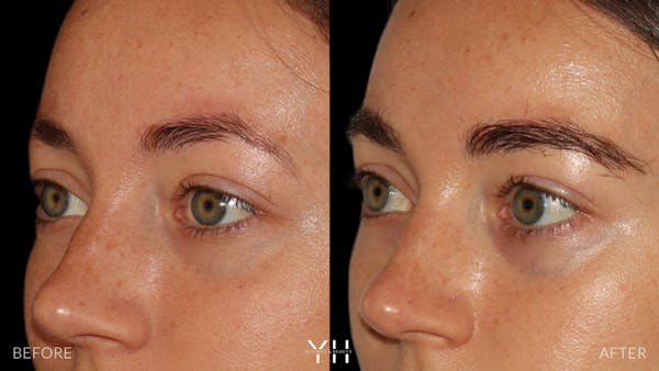 Eyebrow Transplant Before & After Gallery - Patient 234954 - Image 4