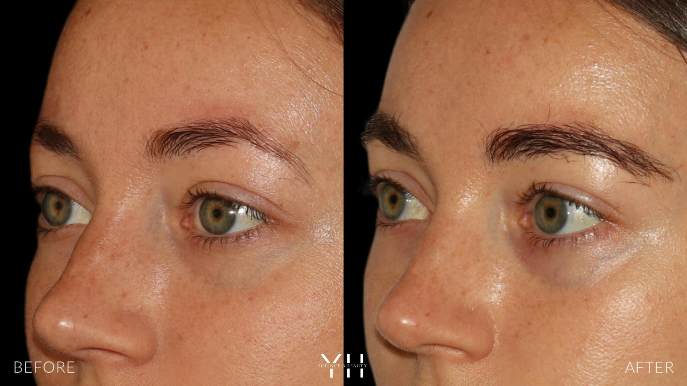 Eyebrow Transplant Before & After Gallery - Patient 234954 - Image 4