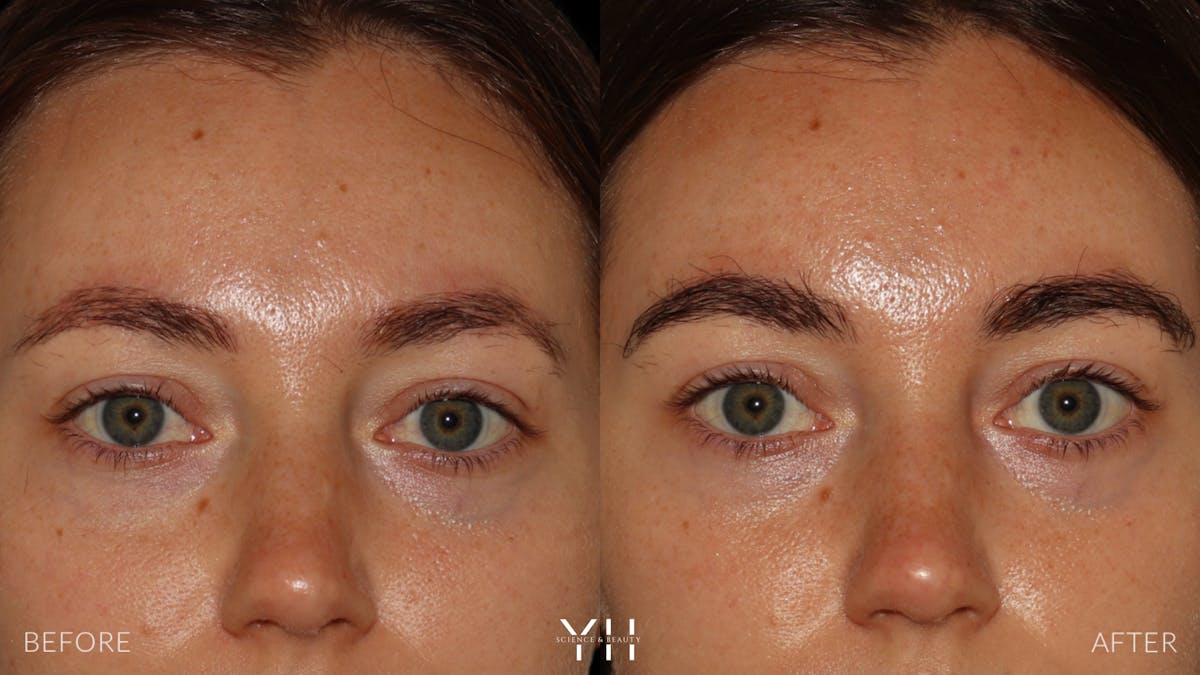 Eyebrow Transplant Before & After Gallery - Patient 234954 - Image 1