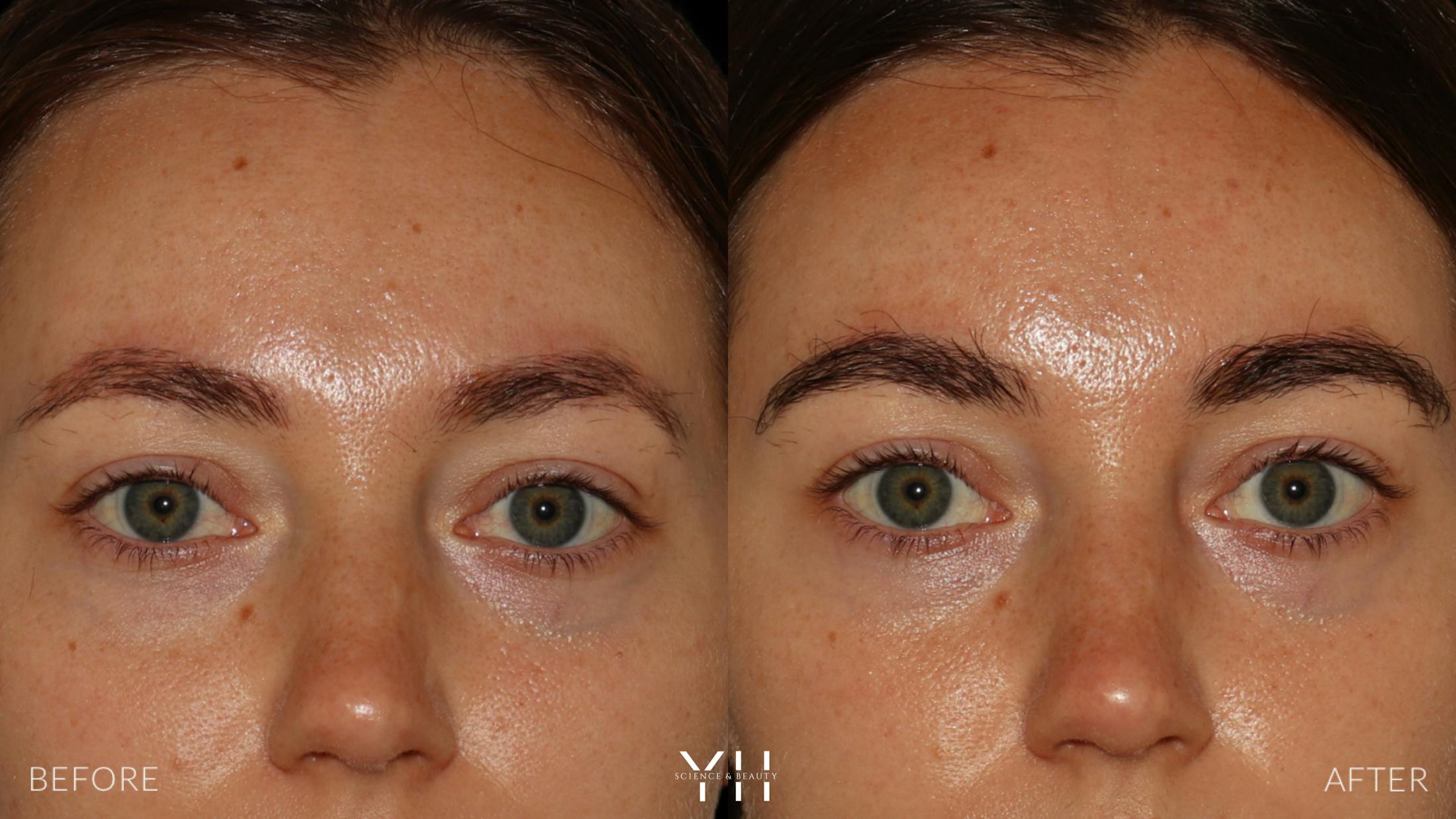 Eyebrow Transplant Before & After Gallery - Patient 234954 - Image 1