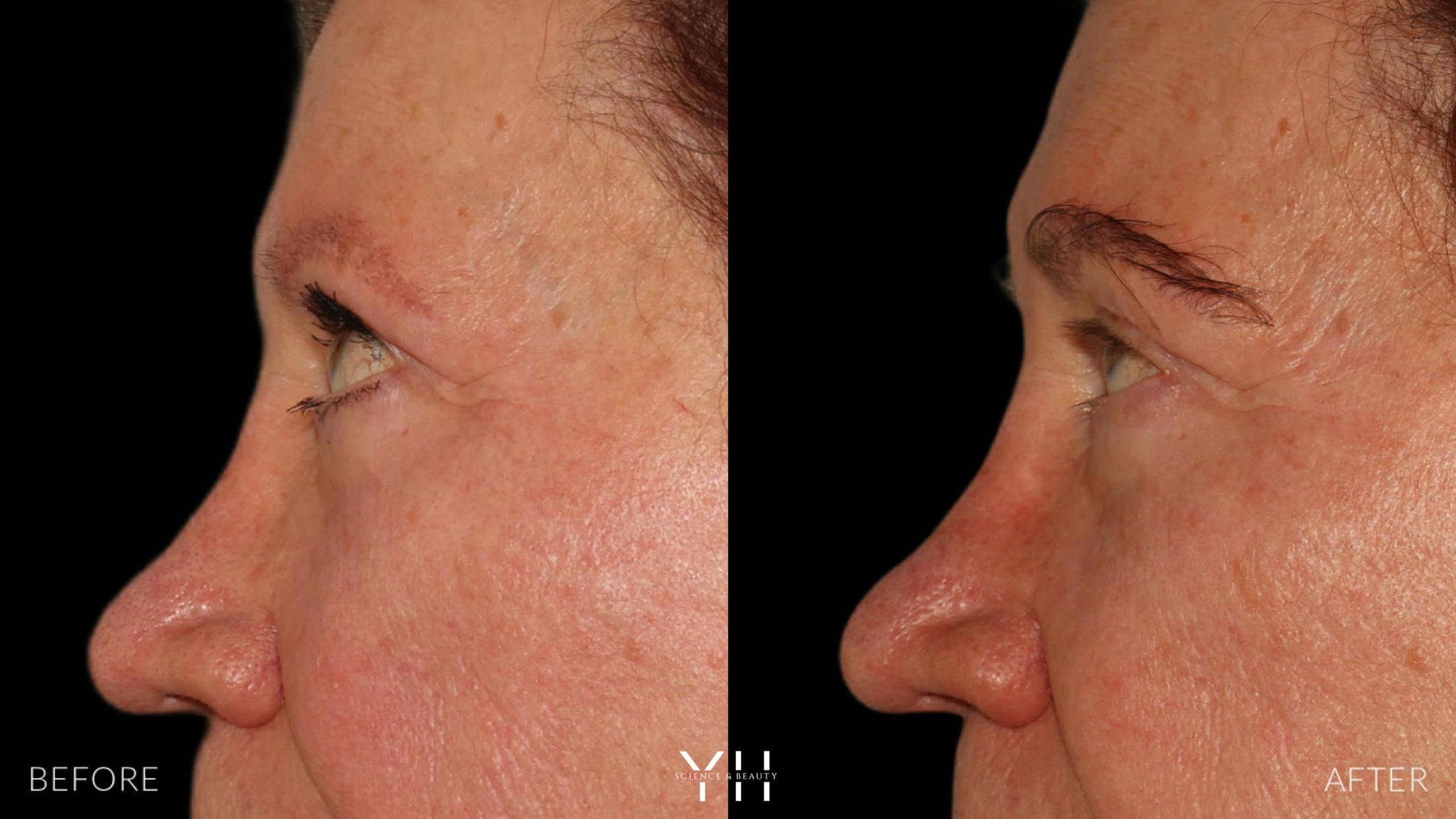 Eyebrow Transplant Before & After Gallery - Patient 218098 - Image 5