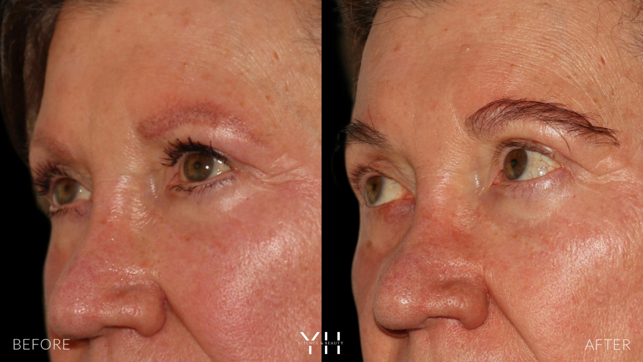 Eyebrow Transplant Before & After Gallery - Patient 218098 - Image 4