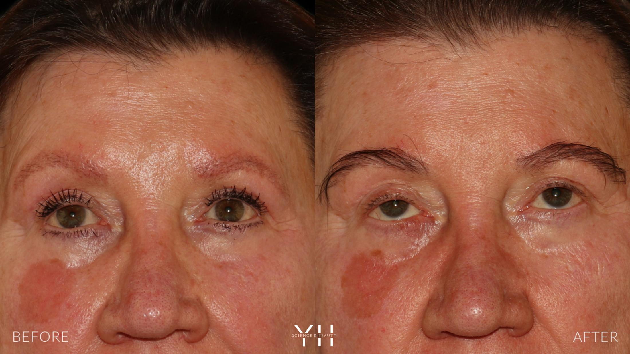 Eyebrow Transplant Before & After Gallery - Patient 218098 - Image 1