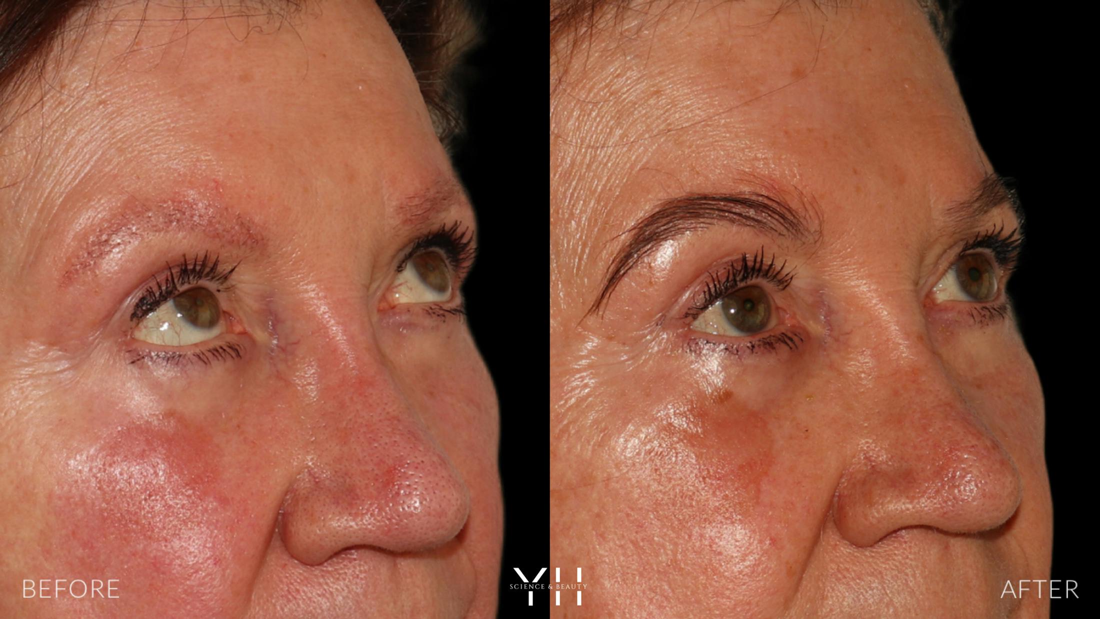 Eyebrow Transplant Before & After Gallery - Patient 218098 - Image 2