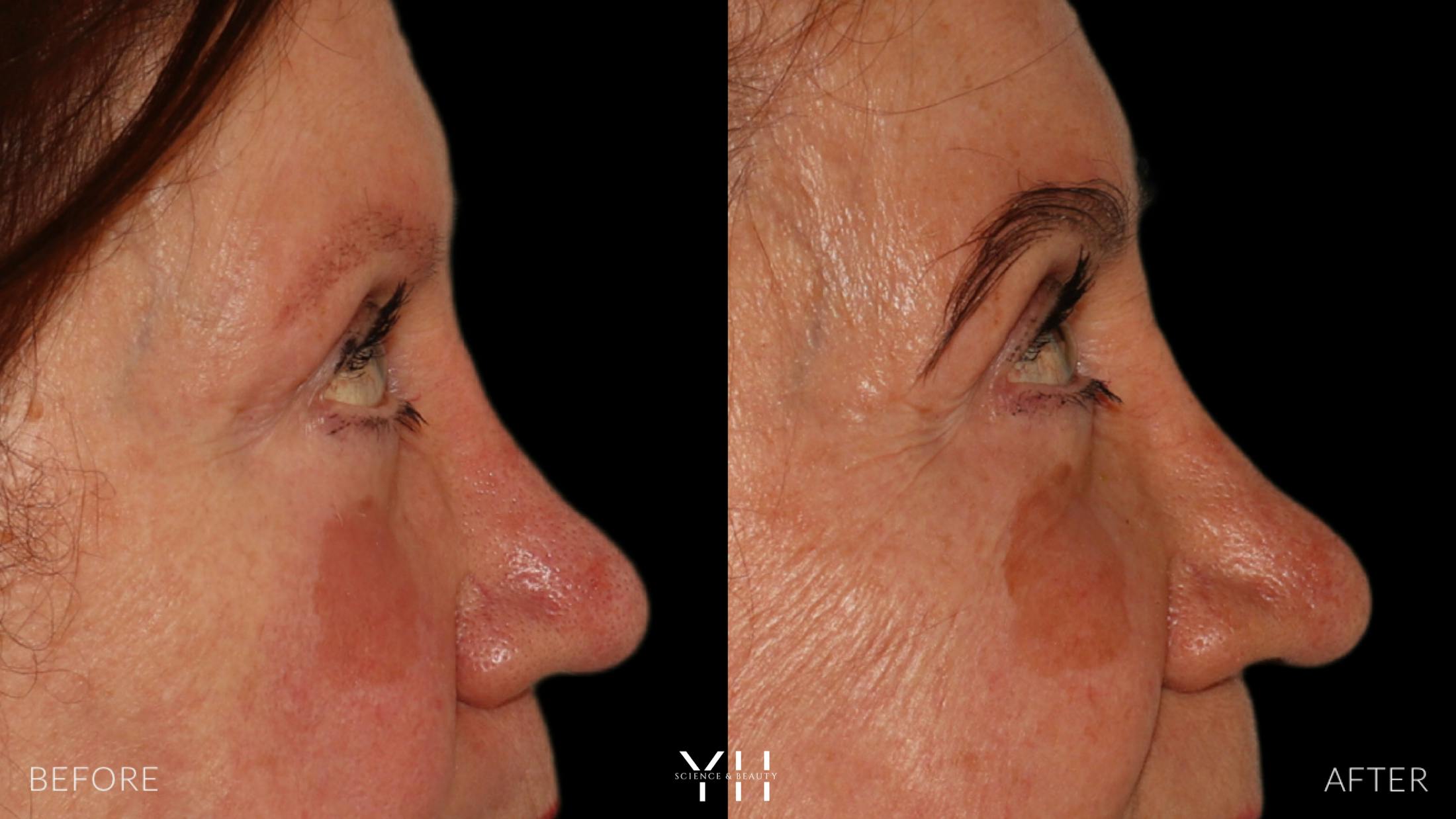 Eyebrow Transplant Before & After Gallery - Patient 218098 - Image 3